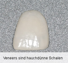 Veneers sind hauchdünne Schalen