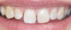 Behandlungsbeispiel 11 für Natural Veneers in der Kaiserberg Klinik. Vor der Behandlung.
