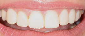Behandlungsbeispiel 11 für Natural Veneers in der Kaiserberg Klinik. Nach der Behandlung.
