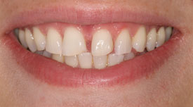 Behandlungsbeispiel 14 für Natural Veneers in der Kaiserberg Klinik. Vor der Behandlung.