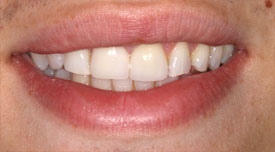 Behandlungsbeispiel 14 für Natural Veneers in der Kaiserberg Klinik. Nach der Behandlung.