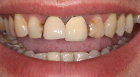 Behandlungsbeispiel 15 für Natural Veneers in der Kaiserberg Klinik. Vor der Behandlung.