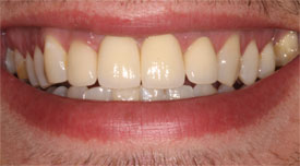 Behandlungsbeispiel 15 für Natural Veneers in der Kaiserberg Klinik. Nach der Behandlung.