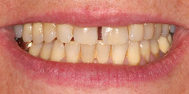 Behandlungsbeispiel 16 für Natural Veneers in der Kaiserberg Klinik. Vor der Behandlung.