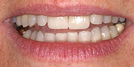 Behandlungsbeispiel 16 für Natural Veneers in der Kaiserberg Klinik. Nach der Behandlung.