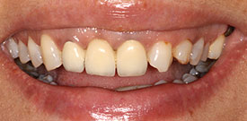 Behandlungsbeispiel 17 für Natural Veneers in der Kaiserberg Klinik. Vor der Behandlung.