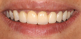 Behandlungsbeispiel 17 für Natural Veneers in der Kaiserberg Klinik. Nach der Behandlung.