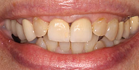 Behandlungsbeispiel 18 für Natural Veneers in der Kaiserberg Klinik. Vor der Behandlung.