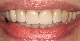 Behandlungsbeispiel 18 für Natural Veneers in der Kaiserberg Klinik. Nach der Behandlung.