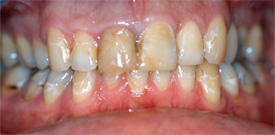 Behandlungsbeispiel 5 für Natural Veneers in der Kaiserberg Klinik. Vor der Behandlung.