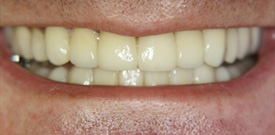 Behandlungsbeispiel 5 für Natural Veneers in der Kaiserberg Klinik. Nach der Behandlung.