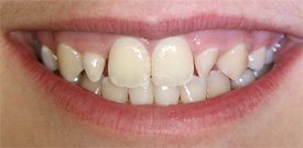 Behandlungsbeispiel 6 für Natural Veneers in der Kaiserberg Klinik. Vor der Behandlung.