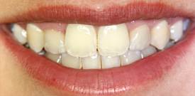 Behandlungsbeispiel 6 für Natural Veneers in der Kaiserberg Klinik. Nach der Behandlung.