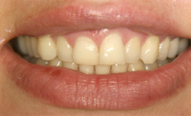 Behandlungsbeispiel 7 für Natural Veneers in der Kaiserberg Klinik. Vor der Behandlung.