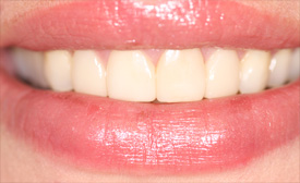 Behandlungsbeispiel 7 für Natural Veneers in der Kaiserberg Klinik. Nach der Behandlung.