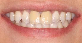 Behandlungsbeispiel 8 für Natural Veneers in der Kaiserberg Klinik. Vor der Behandlung.