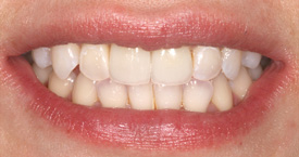 Behandlungsbeispiel 8 für Natural Veneers in der Kaiserberg Klinik. Nach der Behandlung.